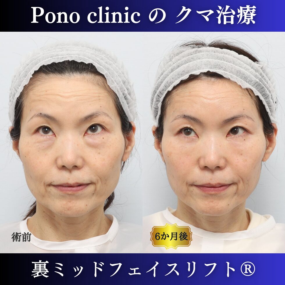 裏ミッド、PRPF額こめかみ眉間 (5)