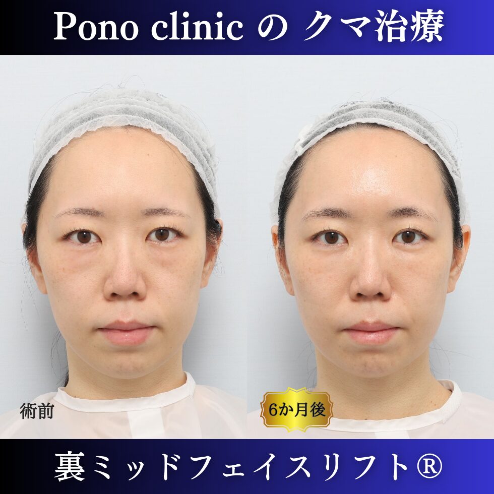 目の下のクマ、目の下のたるみ、クマ取り、裏ハムラ、裏ミッドフェイスリフト、30代の症例 (7)