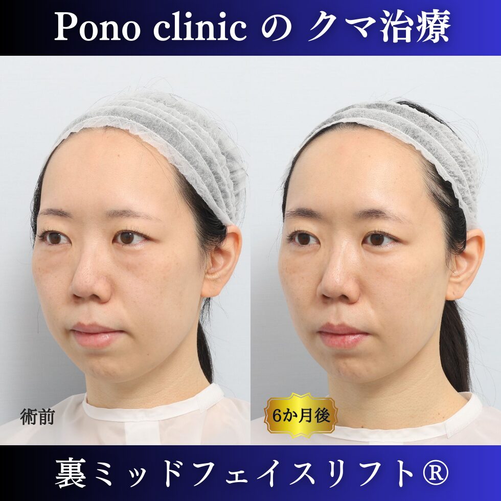 目の下のクマ、目の下のたるみ、クマ取り、裏ハムラ、裏ミッドフェイスリフト、30代の症例 (3)