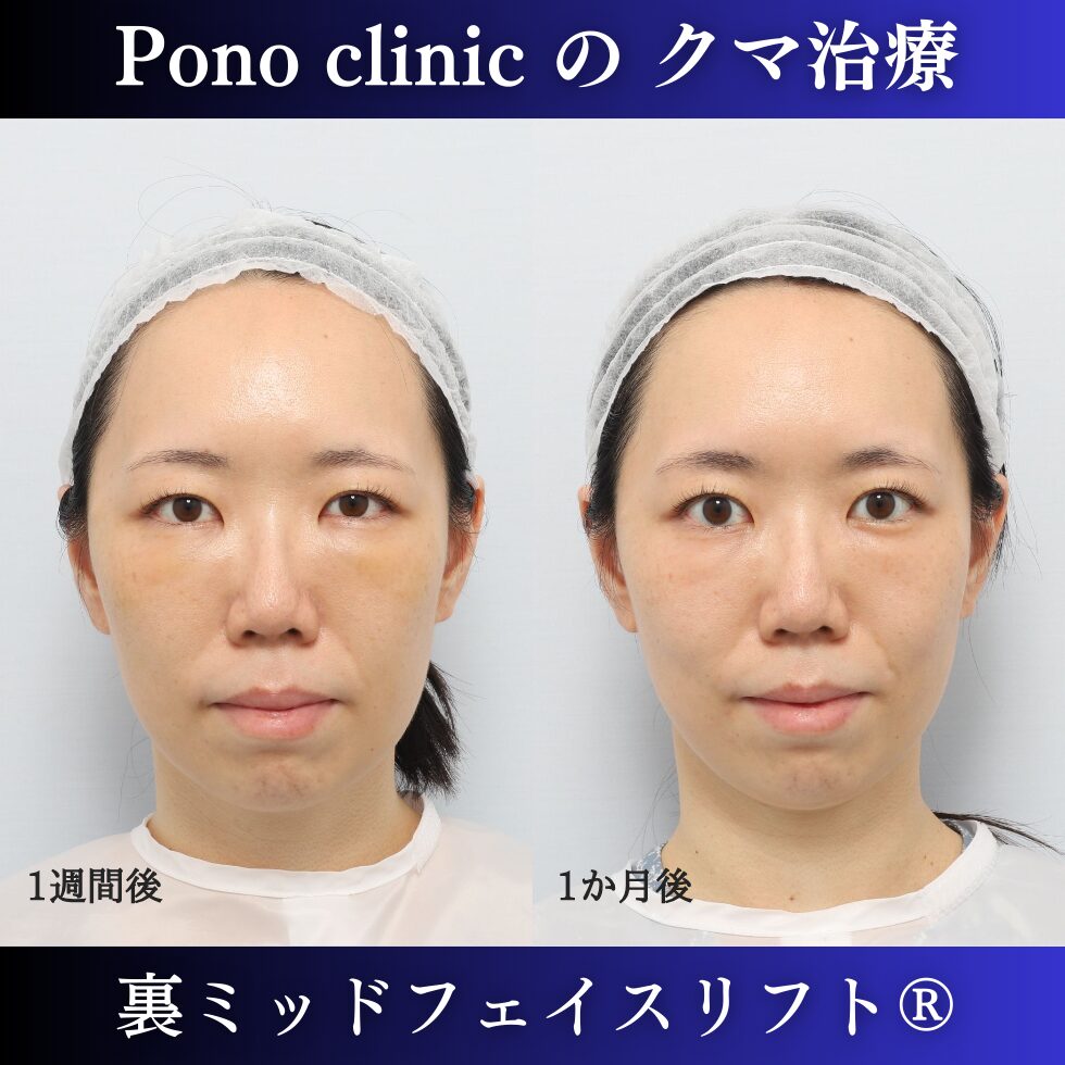 目の下のクマ、目の下のたるみ、クマ取り、裏ハムラ、裏ミッドフェイスリフト、30代の症例 (1)