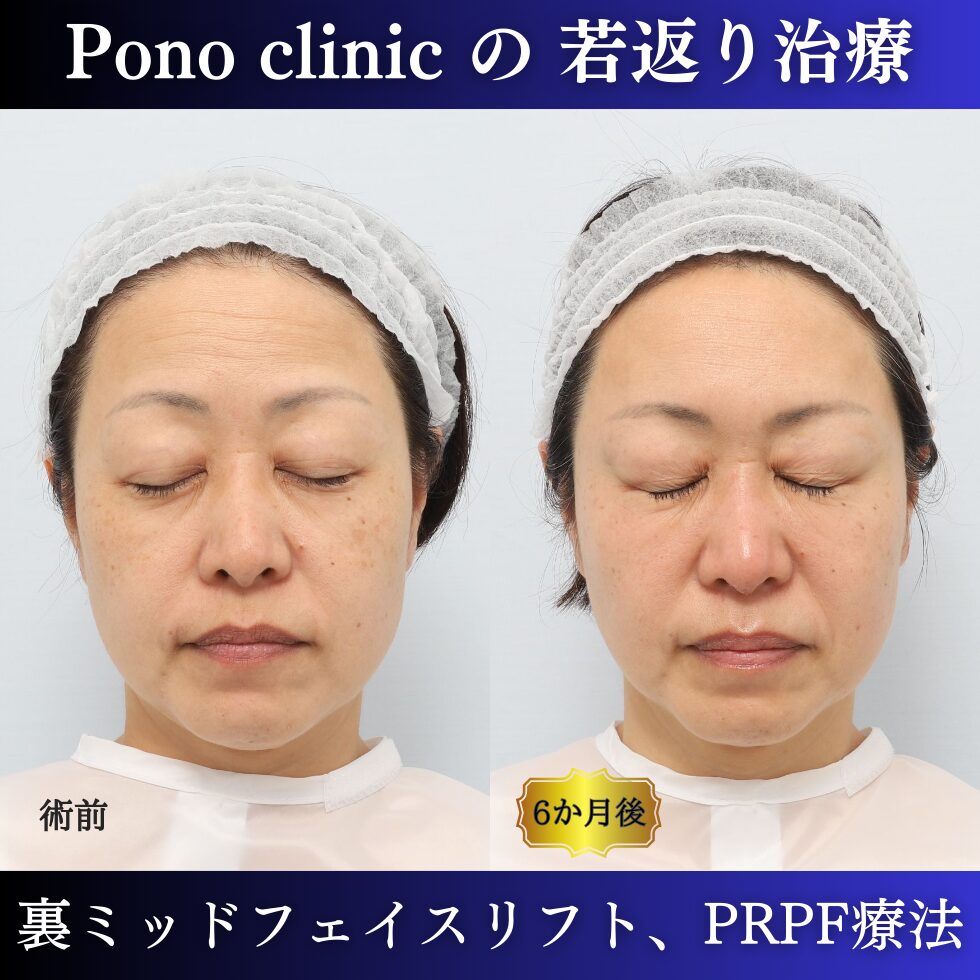 裏ミッドフェイスリフト、PRPF療法、クマ治療、眉間のしわ、額のしわ、コメカミの凹み、50代の症例 (6)