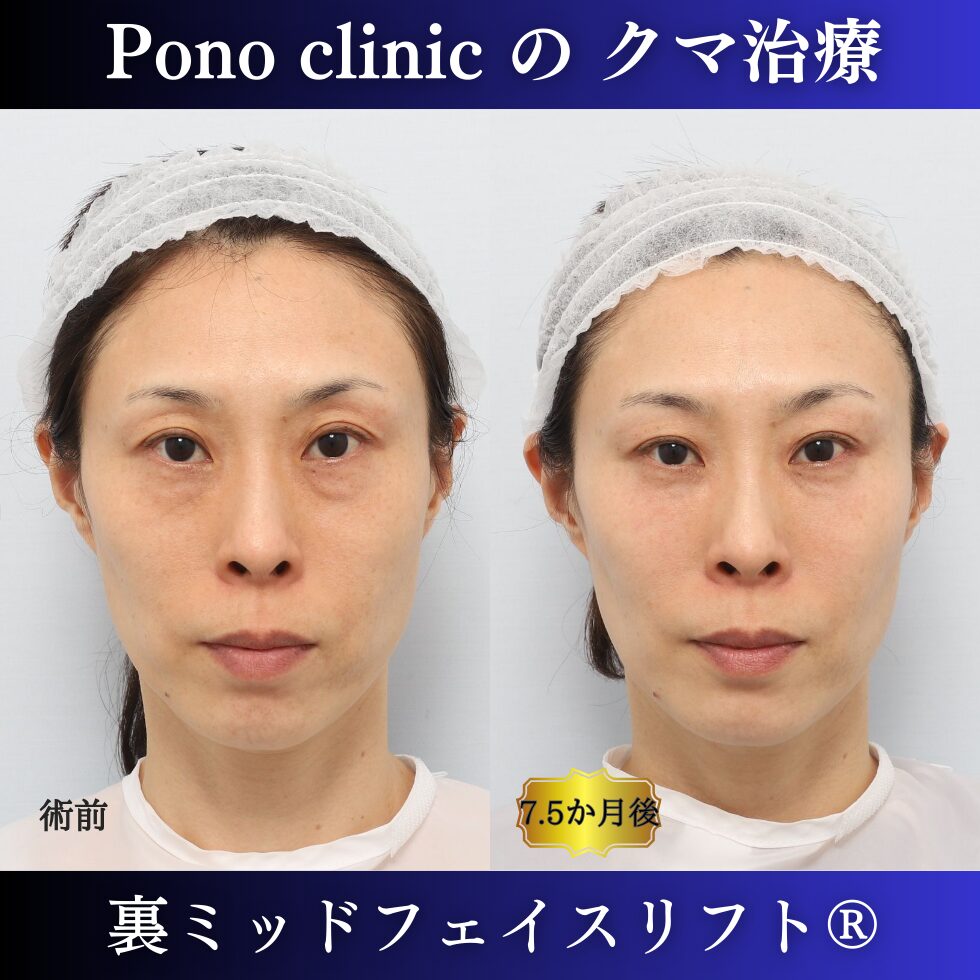 目の下のクマ治療、裏ハムラ、裏ミッドフェイスリフト、中顔面リフト、目の上のくぼみ、40代の症例 (9)