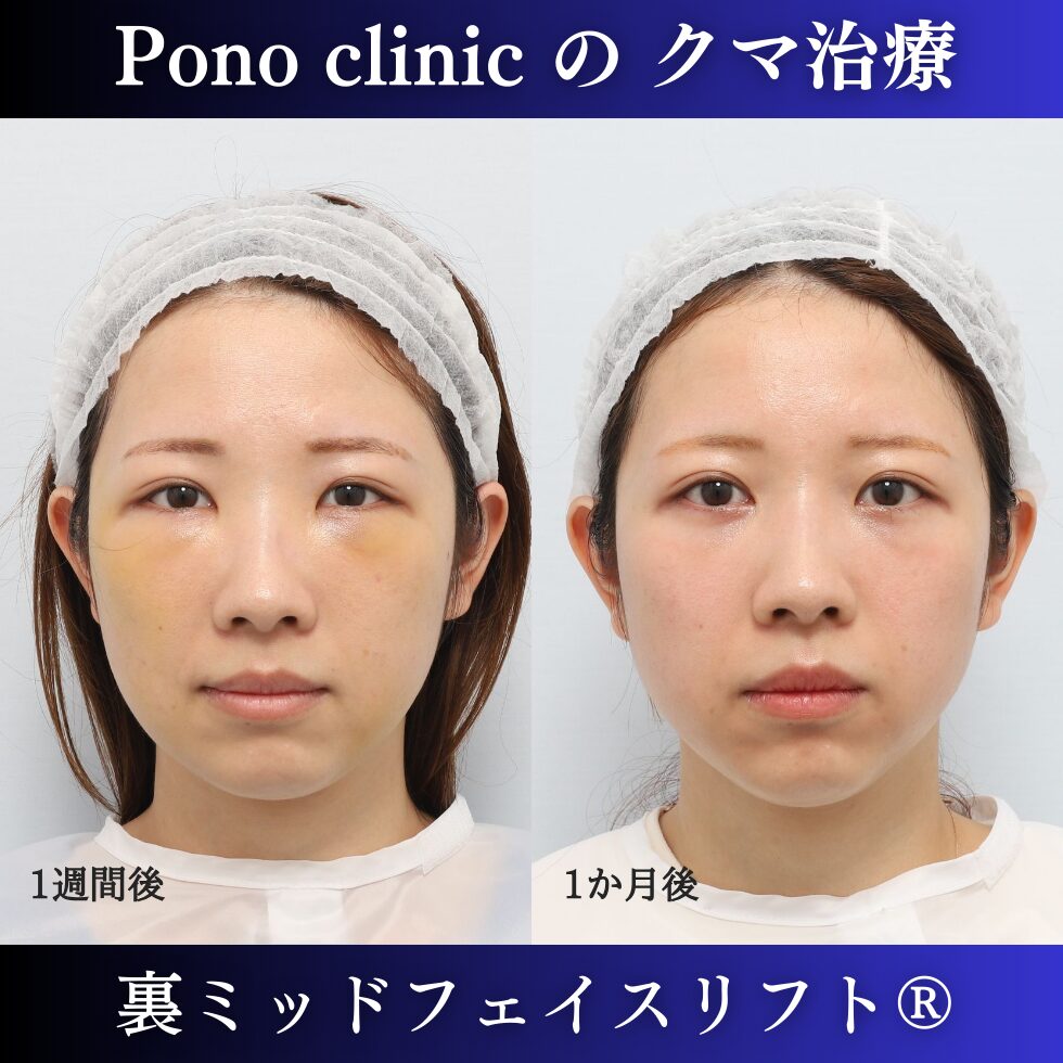 目の下のクマ取り、裏ミッドフェイスリフト、裏ハムラ、20代の症例 (1)