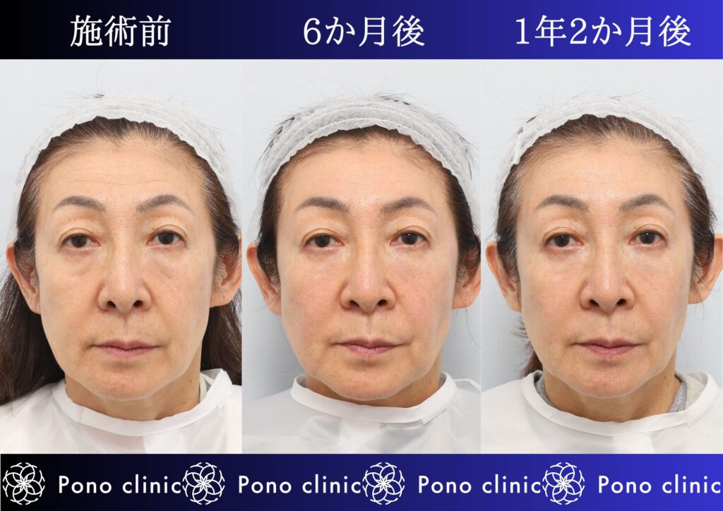 しわ治療、PRPF療法、額、こめかみ、目の下、ゴルゴライン、法令線、マリオネットライン、頬、60代の症例 (4)