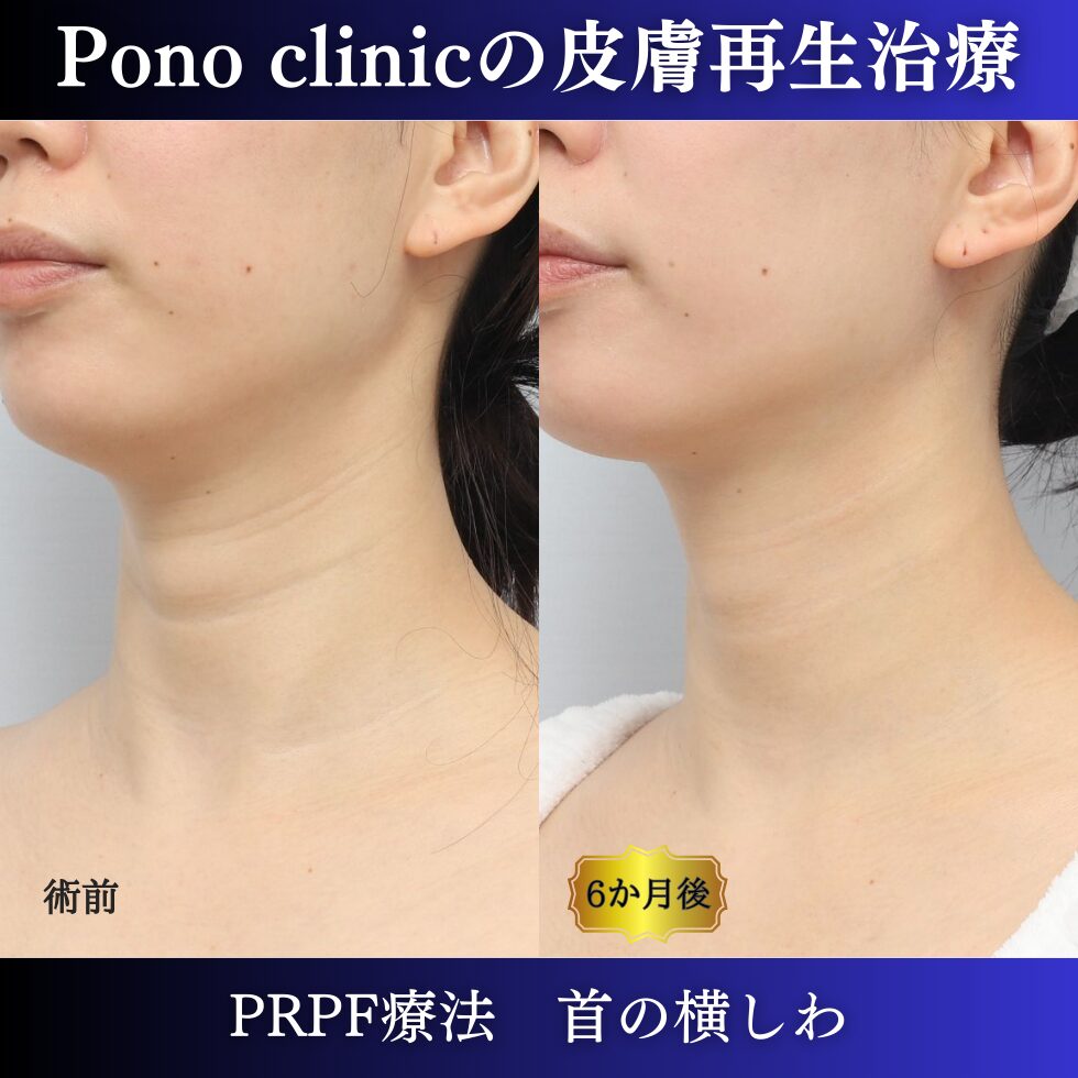 首のしわ、しわ治療、PRPF療法、30代の症例 (3)