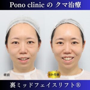 目の下のクマ、目の下のたるみ、クマ取り、裏ハムラ、裏ミッドフェイスリフト、30代の症例 (4)
