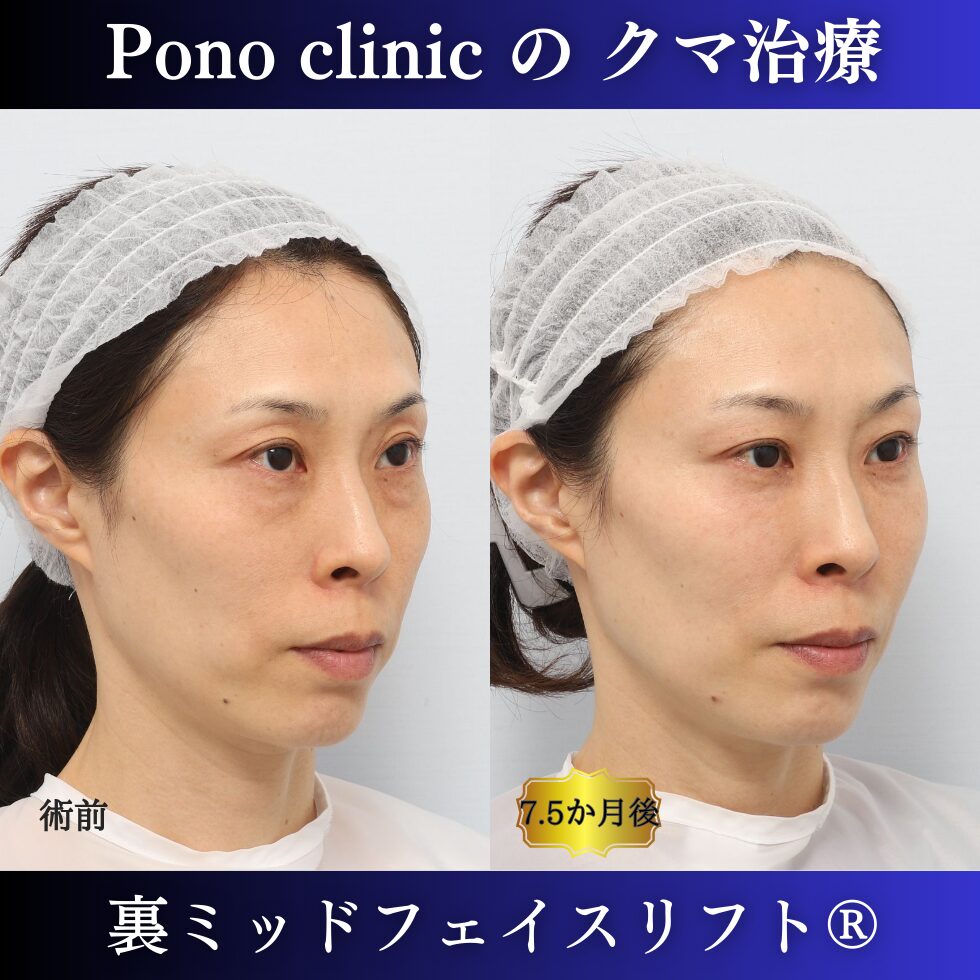 目の下のクマ治療、裏ハムラ、裏ミッドフェイスリフト、中顔面リフト、目の上のくぼみ、40代の症例 (2)