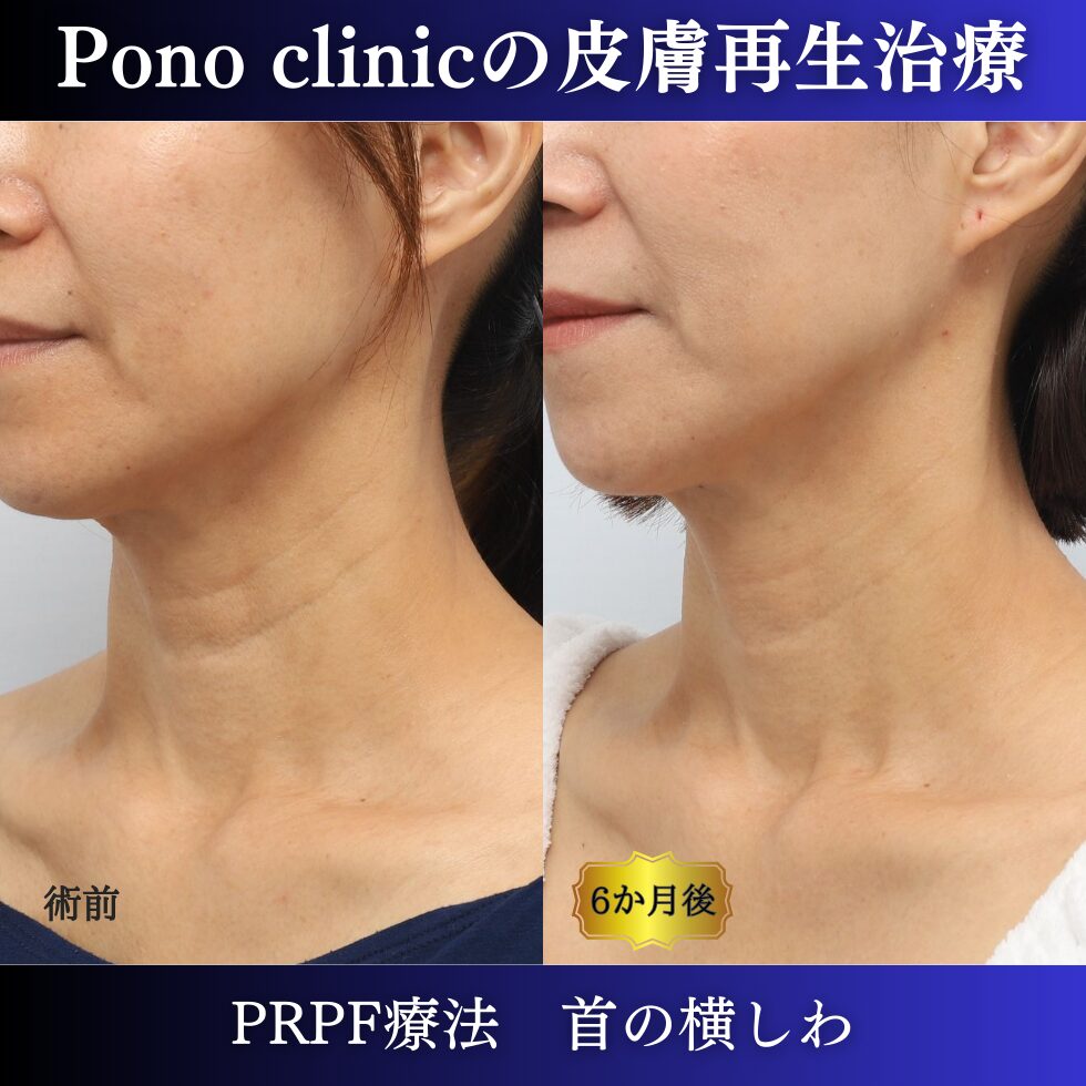 首のしわ、しわ治療、PRPF、50代の症例 (2)