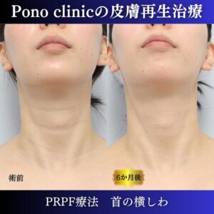 首のしわ、しわ治療、PRPF療法、30代の症例 (1)