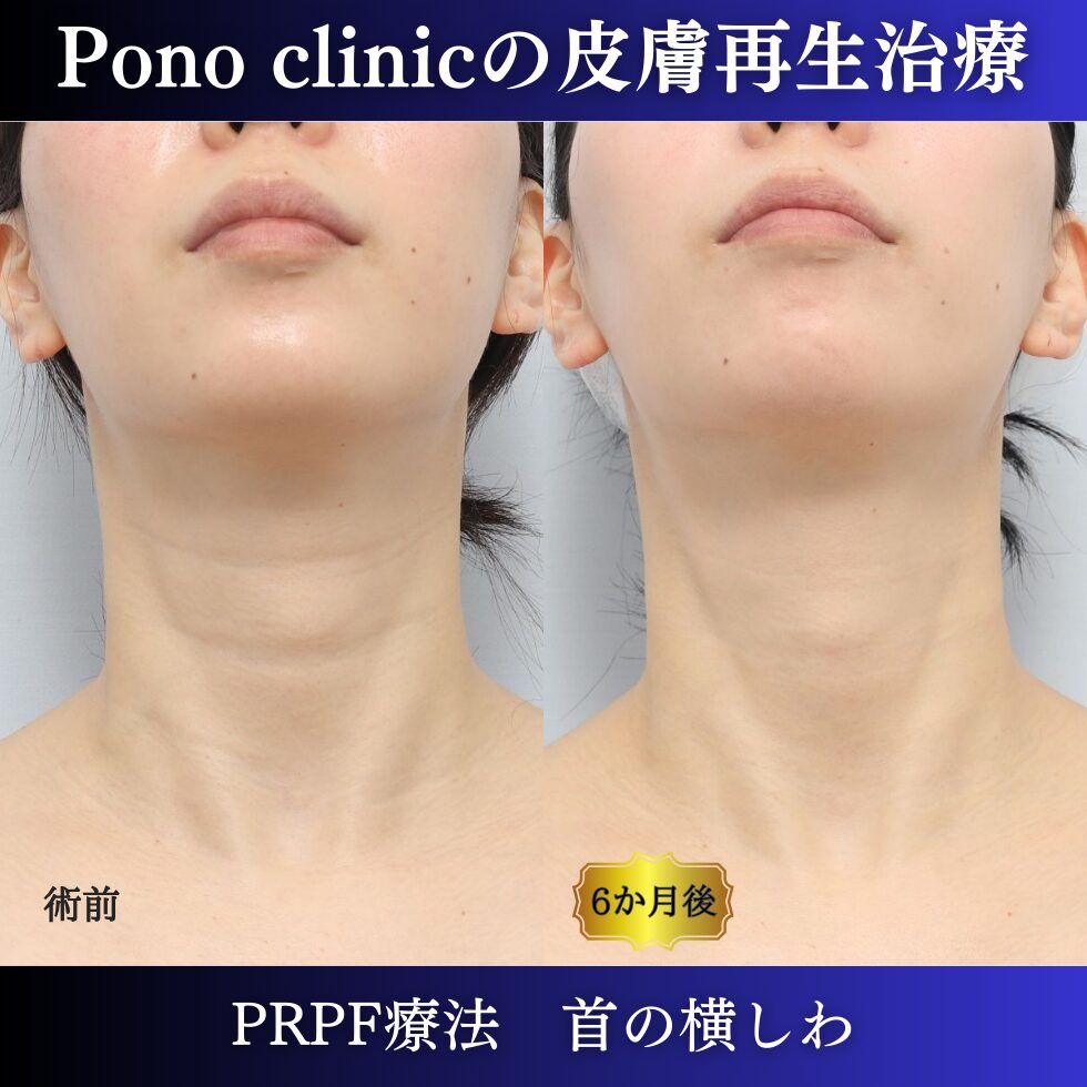 首のしわ、しわ治療、PRPF療法、30代の症例 (1)