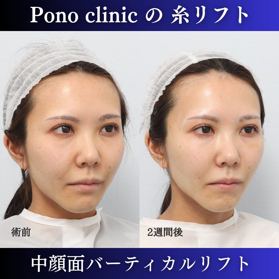 糸リフト、中顔面リフト、バーティカルリフト、小顔治療、20代の症例 (1)