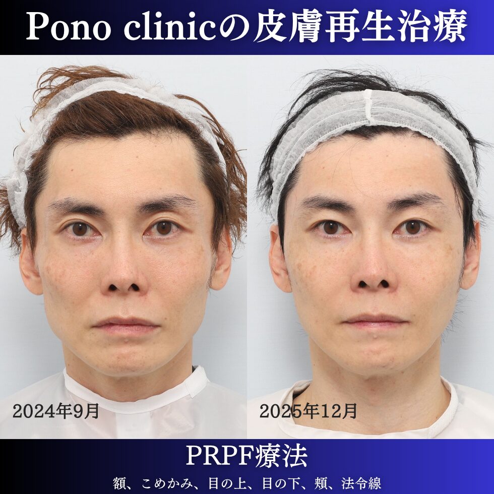 PRPF療法、若返り治療、しわ治療、法令線、目の上のくぼみ、頬コケ、40代男性の症例 (1)
