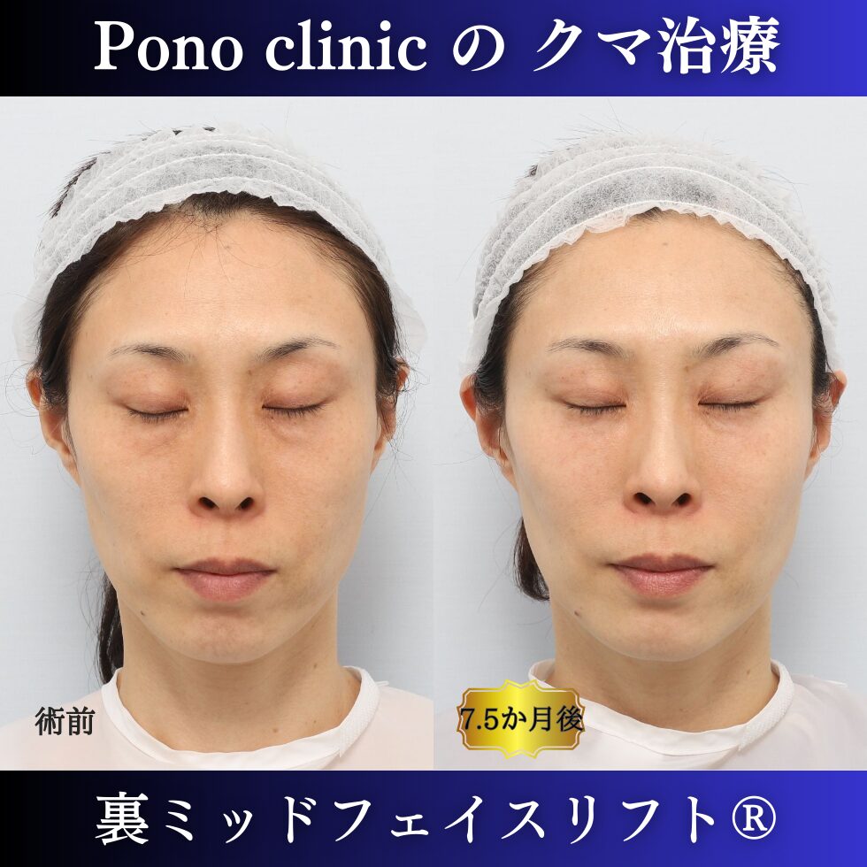 目の下のクマ治療、裏ハムラ、裏ミッドフェイスリフト、中顔面リフト、目の上のくぼみ、40代の症例 (8)