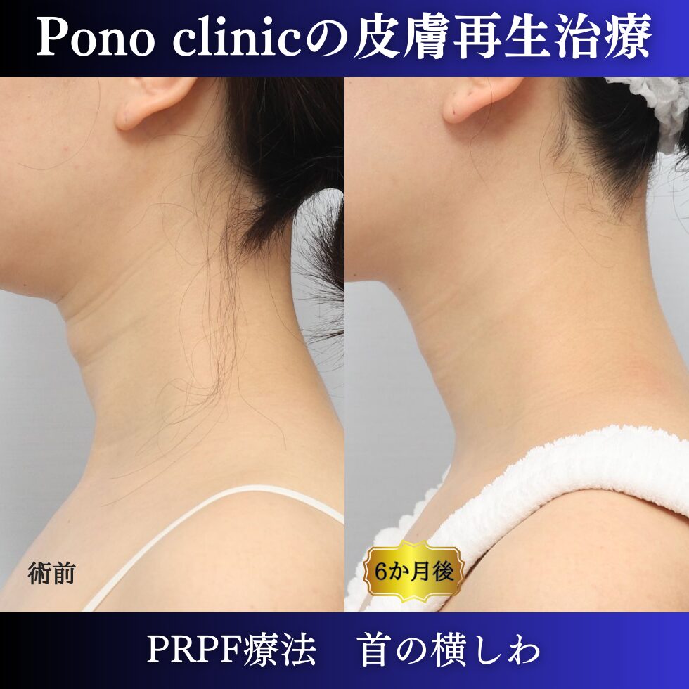 首のしわ、しわ治療、PRPF療法、30代の症例 (2)