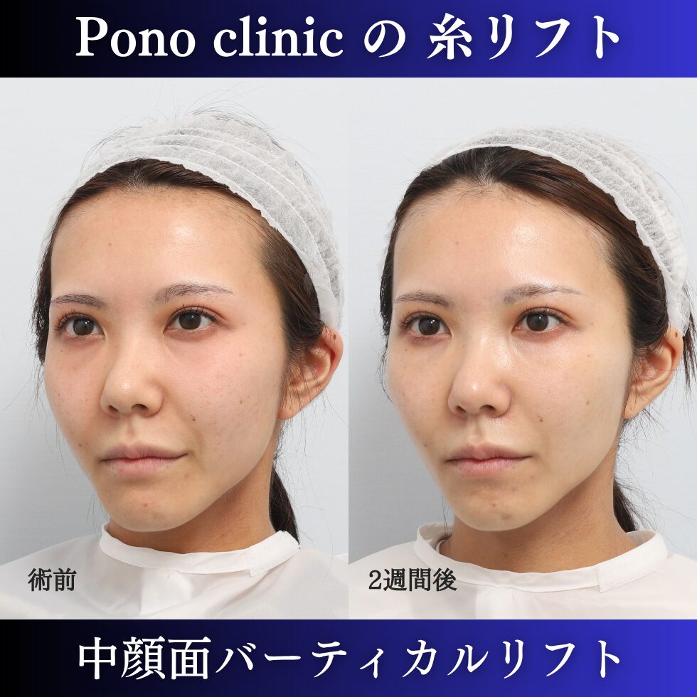 糸リフト、中顔面リフト、バーティカルリフト、小顔治療、20代の症例 (2)