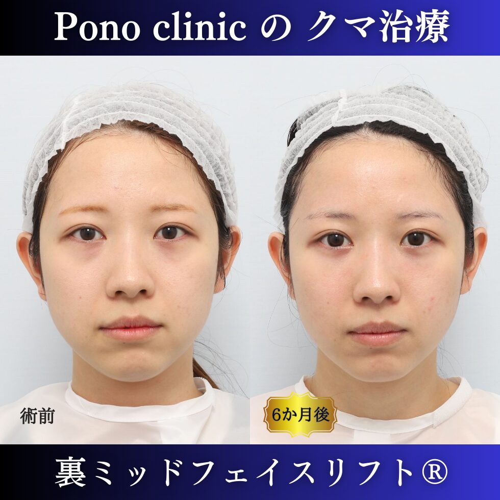 目の下のクマ取り、裏ミッドフェイスリフト、裏ハムラ、20代の症例 (7)