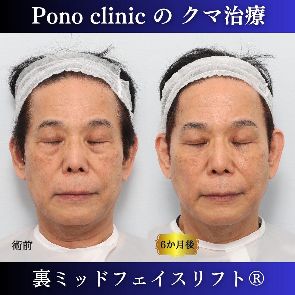 男性のクマ治療、50代の症例、目の下のたるみ、目の下のクマ、黒クマ (6)