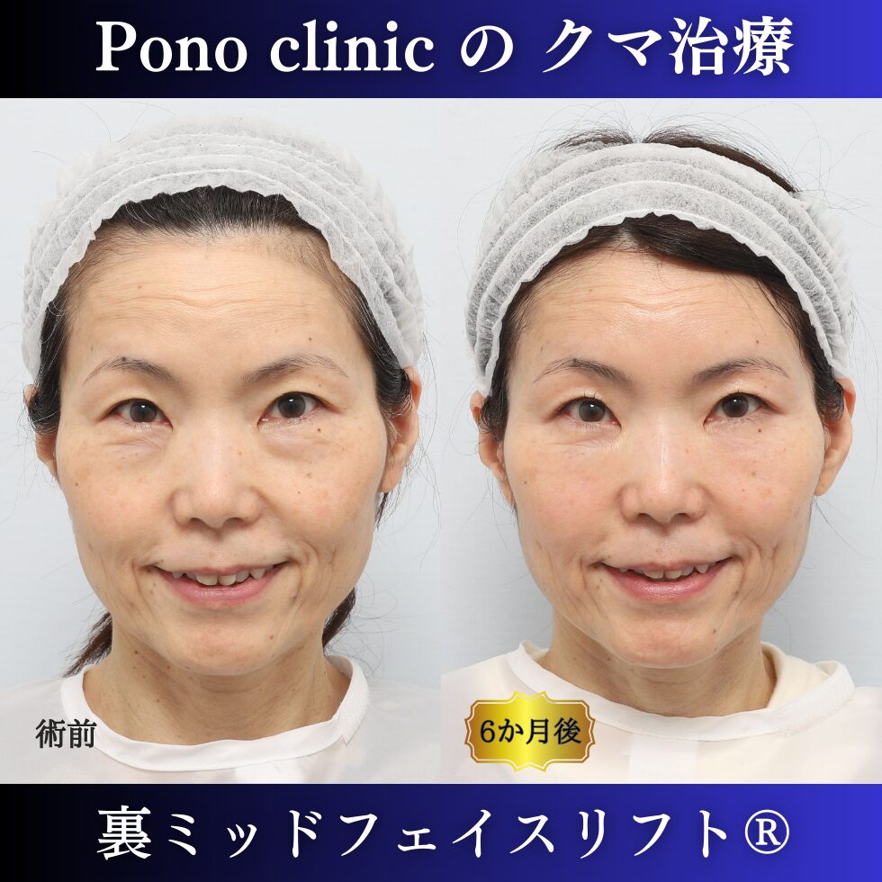 裏ミッド、PRPF額こめかみ眉間 (4)