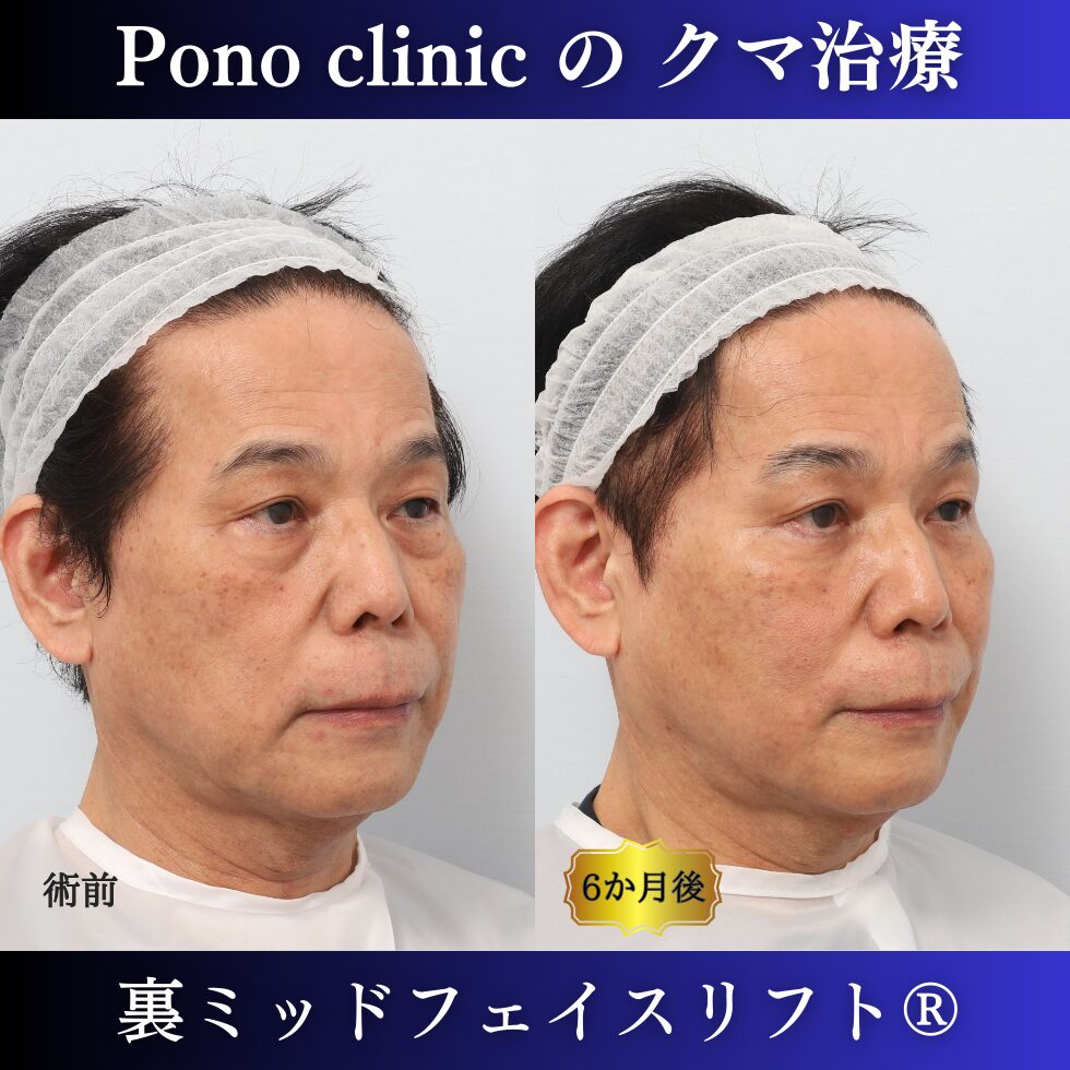 男性のクマ治療、50代の症例、目の下のたるみ、目の下のクマ、黒クマ (2)