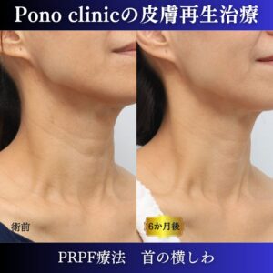 首のしわ、しわ治療、PRPF、50代の症例 (3)