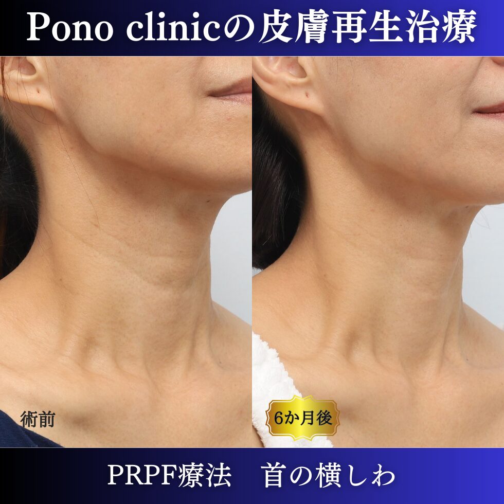 首のしわ、しわ治療、PRPF、50代の症例 (3)