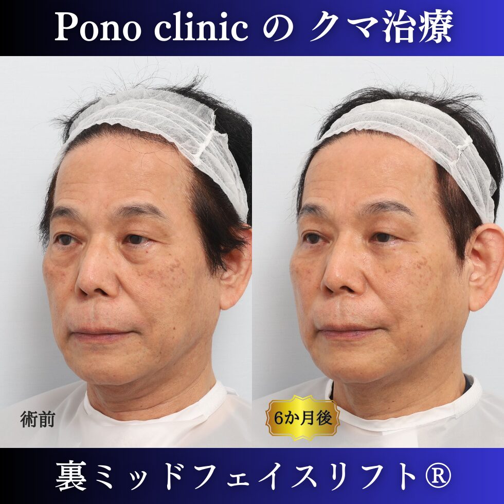 男性のクマ治療、50代の症例、目の下のたるみ、目の下のクマ、黒クマ (3)