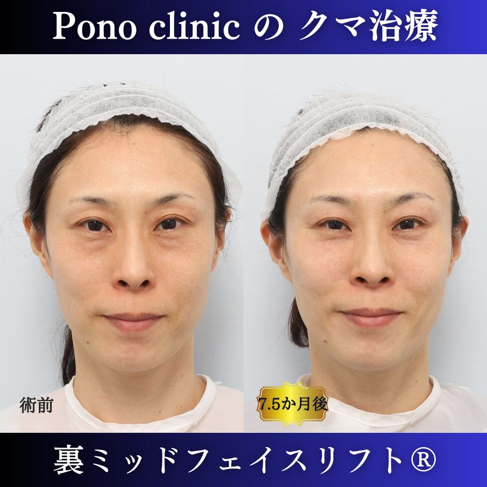 目の下のクマ治療、裏ハムラ、裏ミッドフェイスリフト、中顔面リフト、目の上のくぼみ、40代の症例 (6)