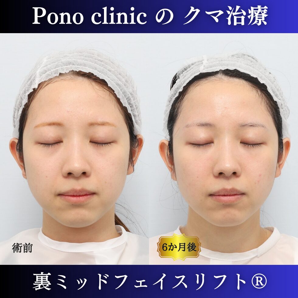 目の下のクマ取り、裏ミッドフェイスリフト、裏ハムラ、20代の症例 (6)