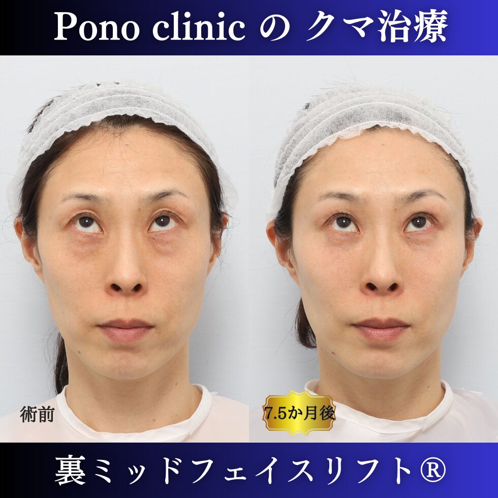 目の下のクマ治療、裏ハムラ、裏ミッドフェイスリフト、中顔面リフト、目の上のくぼみ、40代の症例 (7)