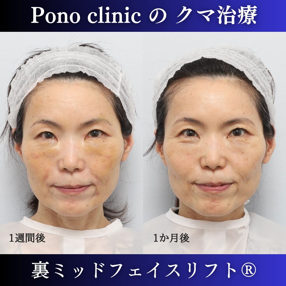 裏ミッドフェイスリフト®、PRPF額こめかみ眉間 