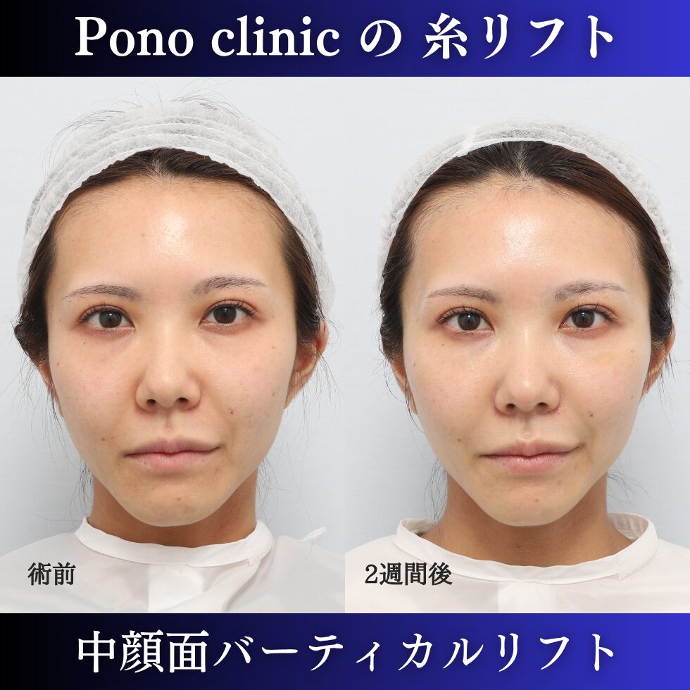 糸リフト、中顔面リフト、バーティカルリフト、小顔治療、20代の症例 (4)