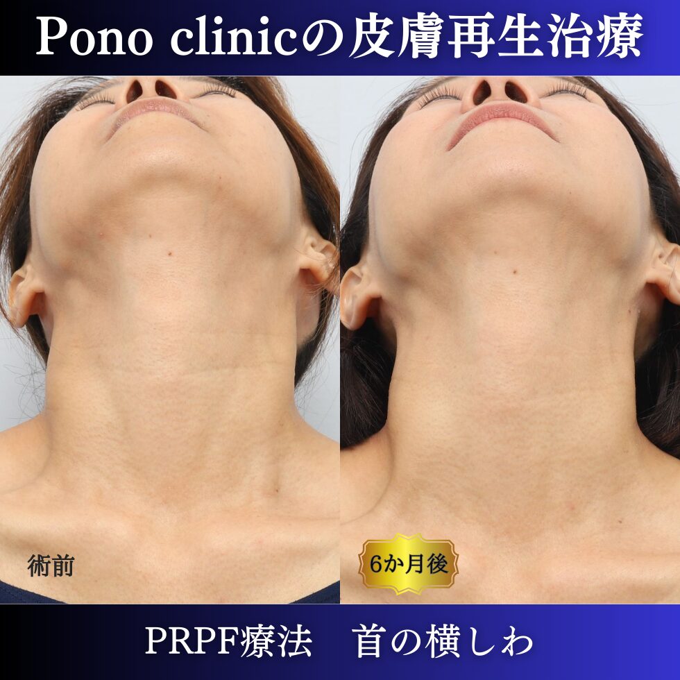 首のしわ、しわ治療、PRPF、50代の症例 (5)