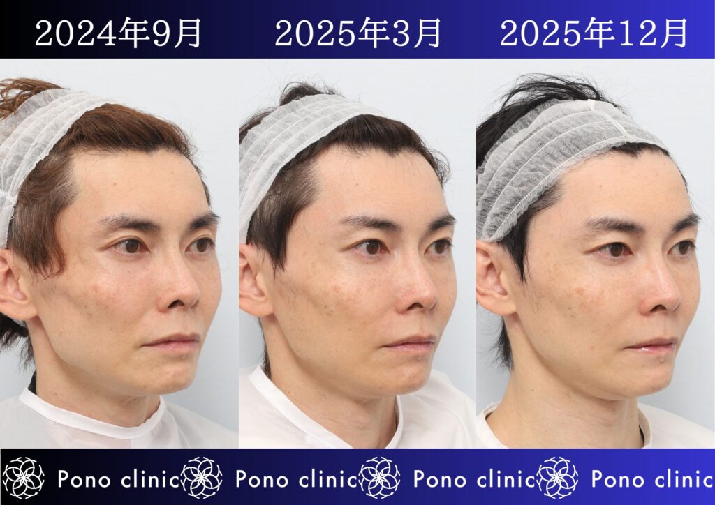 PRPF療法、若返り治療、しわ治療、法令線、目の上のくぼみ、頬コケ、40代男性の症例 (2)