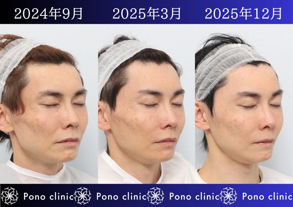 PRPF療法、若返り治療、しわ治療、法令線、目の上のくぼみ、頬コケ、40代男性の症例 (3)