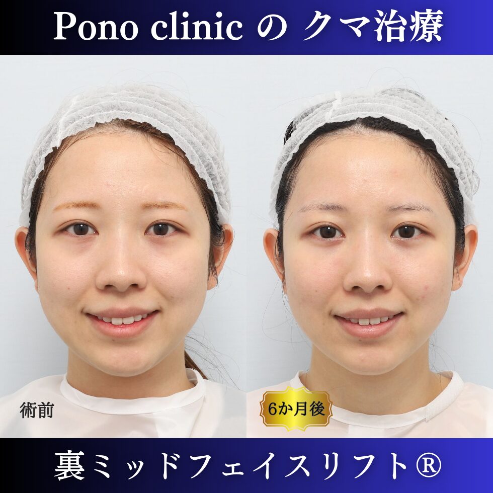 目の下のクマ取り、裏ミッドフェイスリフト、裏ハムラ、20代の症例 (4)