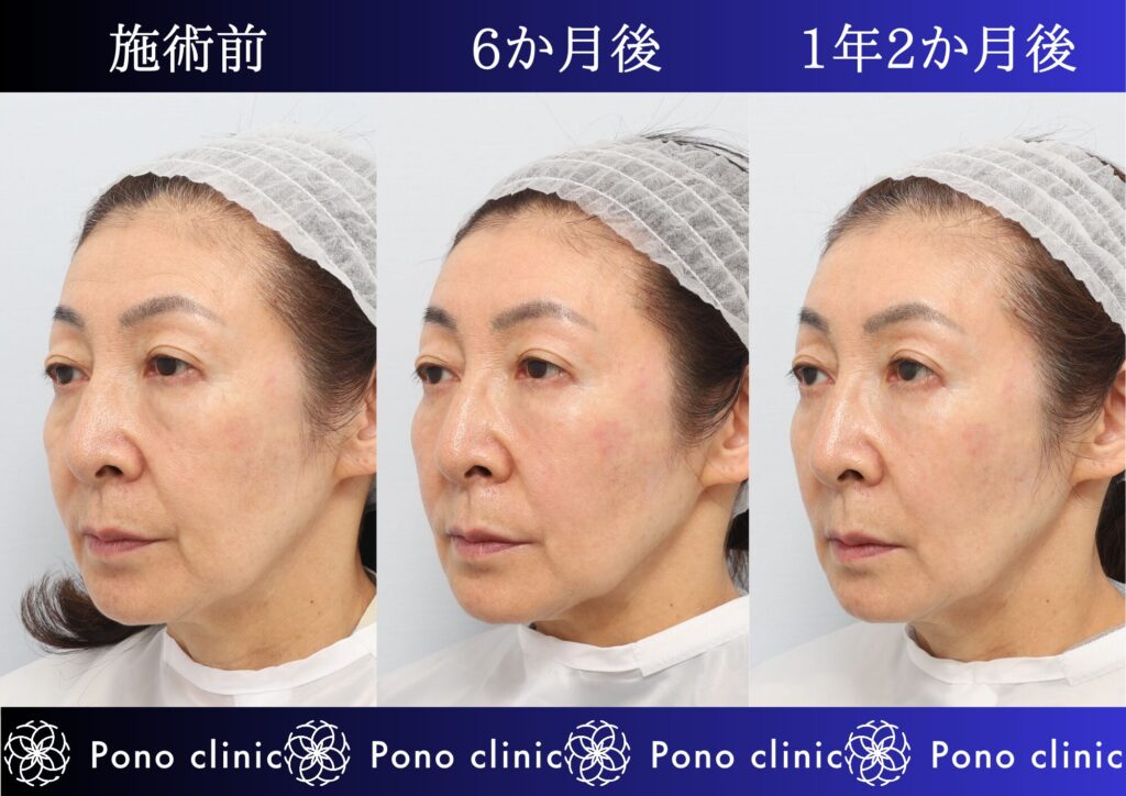 しわ治療、PRPF療法、額、こめかみ、目の下、ゴルゴライン、法令線、マリオネットライン、頬、60代の症例 (3)