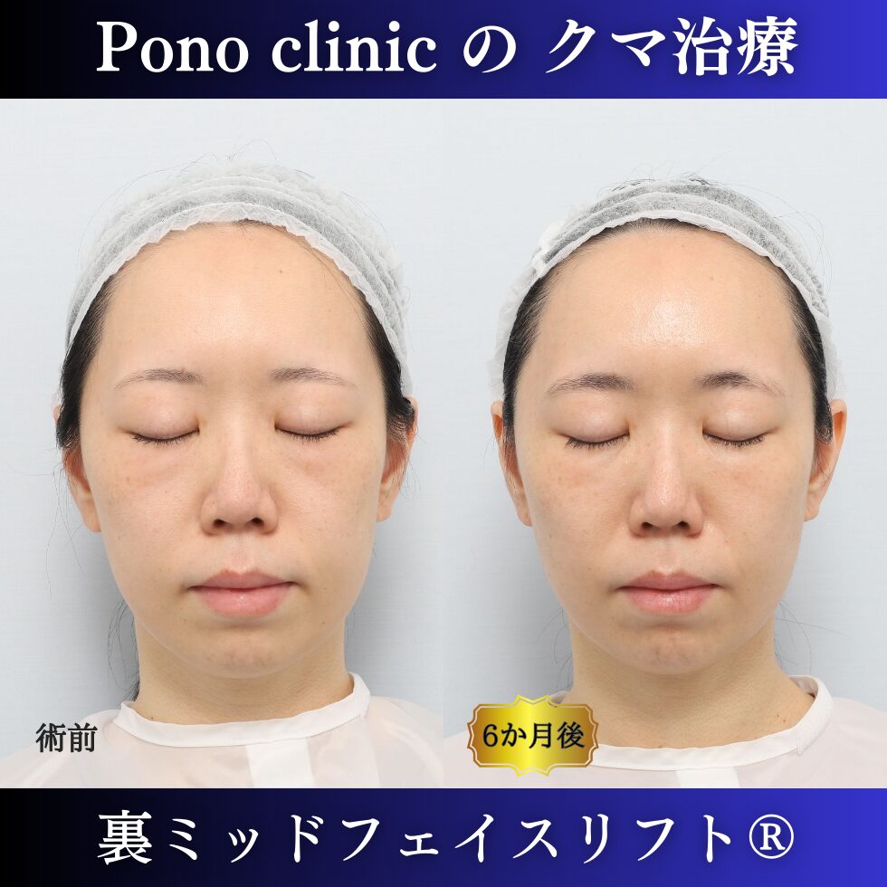 目の下のクマ、目の下のたるみ、クマ取り、裏ハムラ、裏ミッドフェイスリフト、30代の症例 (6)