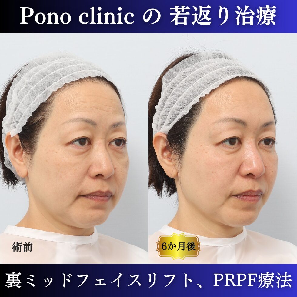 裏ミッドフェイスリフト、PRPF療法、クマ治療、眉間のしわ、額のしわ、コメカミの凹み、50代の症例 (2)