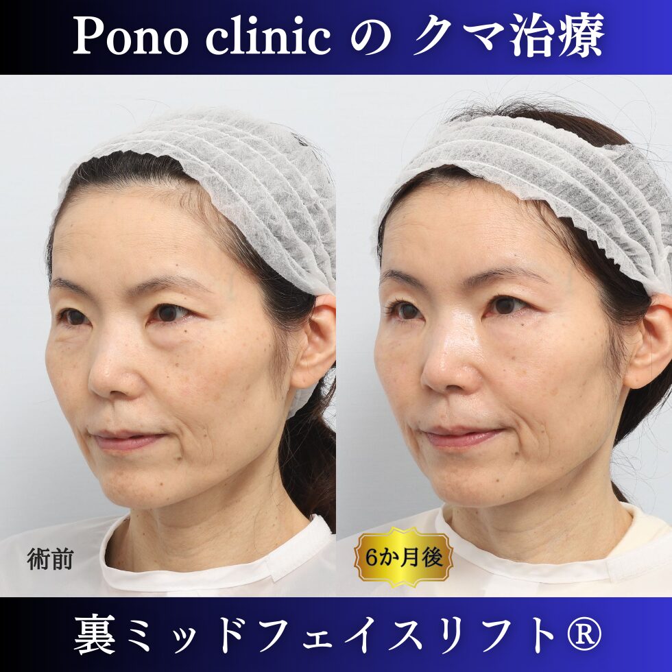 裏ミッド、PRPF額こめかみ眉間 (3)