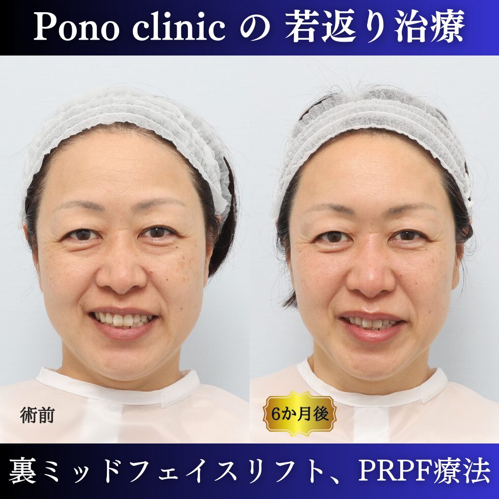 裏ミッドフェイスリフト、PRPF療法、クマ治療、眉間のしわ、額のしわ、コメカミの凹み、50代の症例 (4
