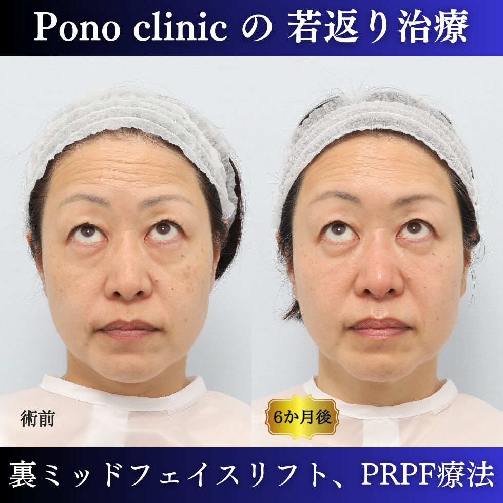 裏ミッドフェイスリフト、PRPF療法、クマ治療、眉間のしわ、額のしわ、コメカミの凹み、50代の症例 (5)