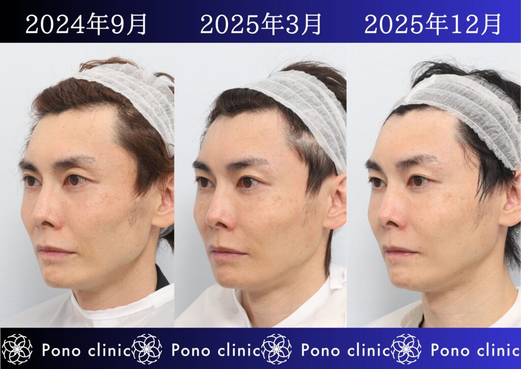 PRPF療法、若返り治療、しわ治療、法令線、目の上のくぼみ、頬コケ、40代男性の症例 (5)