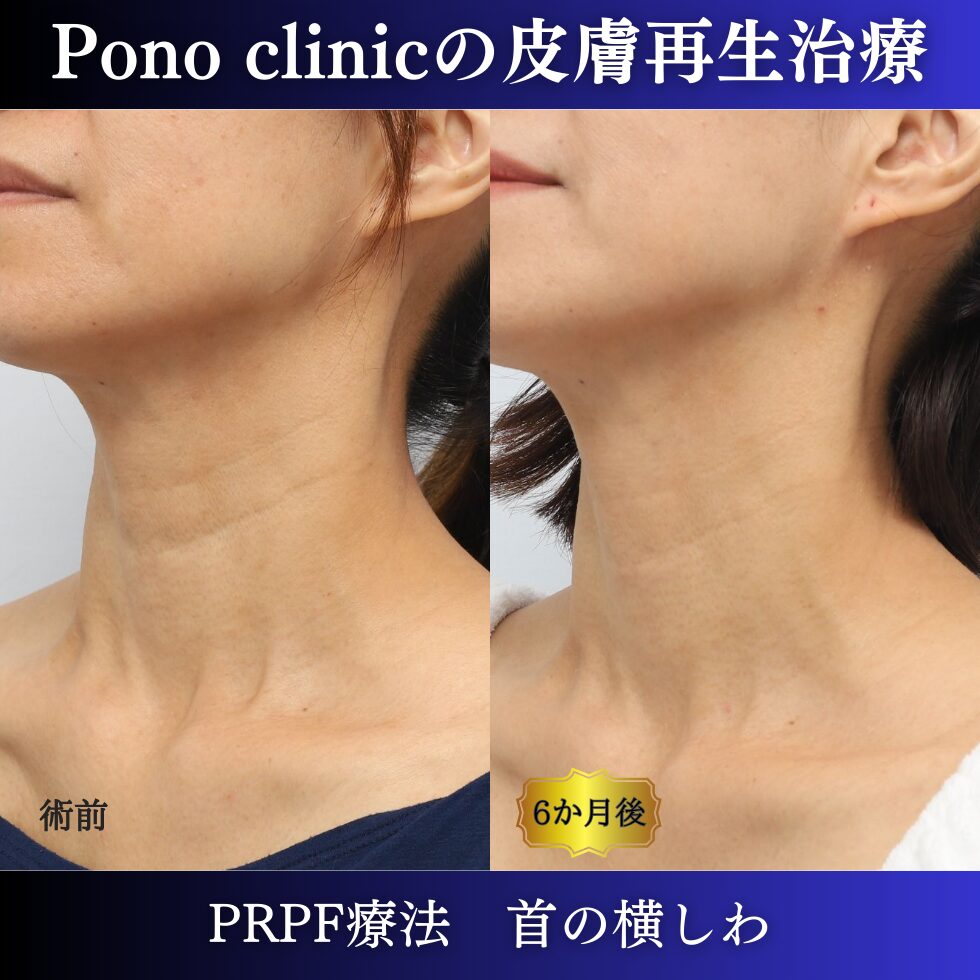 首のしわ、しわ治療、PRPF、50代の症例 (1)