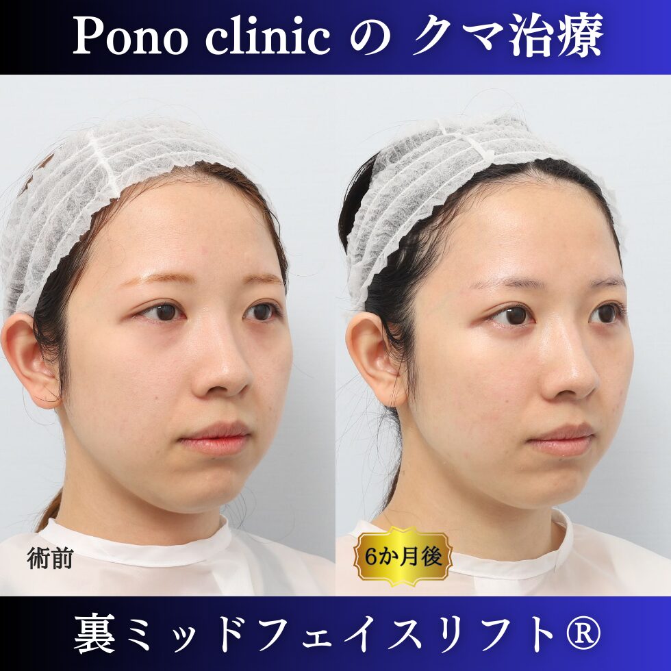 目の下のクマ取り、裏ミッドフェイスリフト、裏ハムラ、20代の症例 (2)