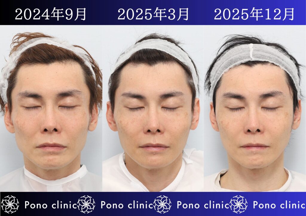 PRPF療法、若返り治療、しわ治療、法令線、目の上のくぼみ、頬コケ、40代男性の症例 (6)