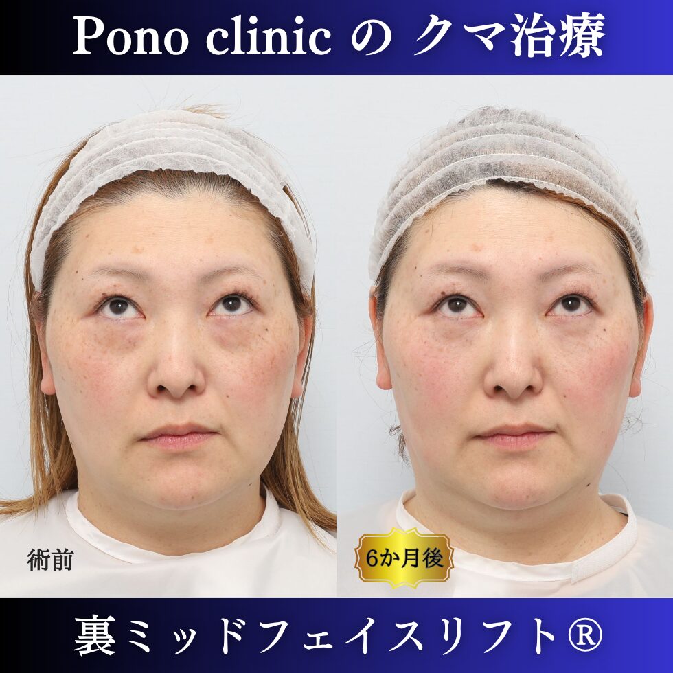 裏ミッドフェイスリフト®、骨膜下リフト、目の下のクマ取り、40代の症例 (4)