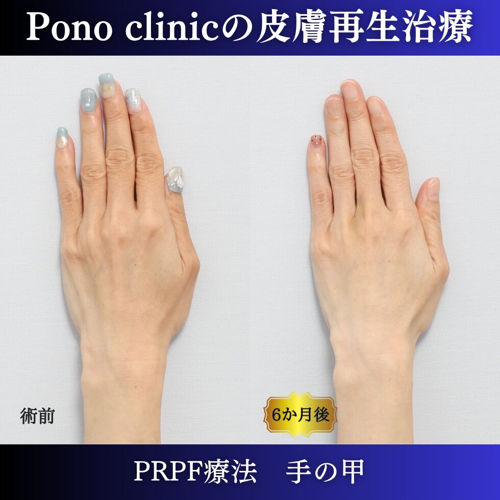 手の甲の若返り、手ののゴツゴツ、PRPF療法 、40代の症例 (2)
