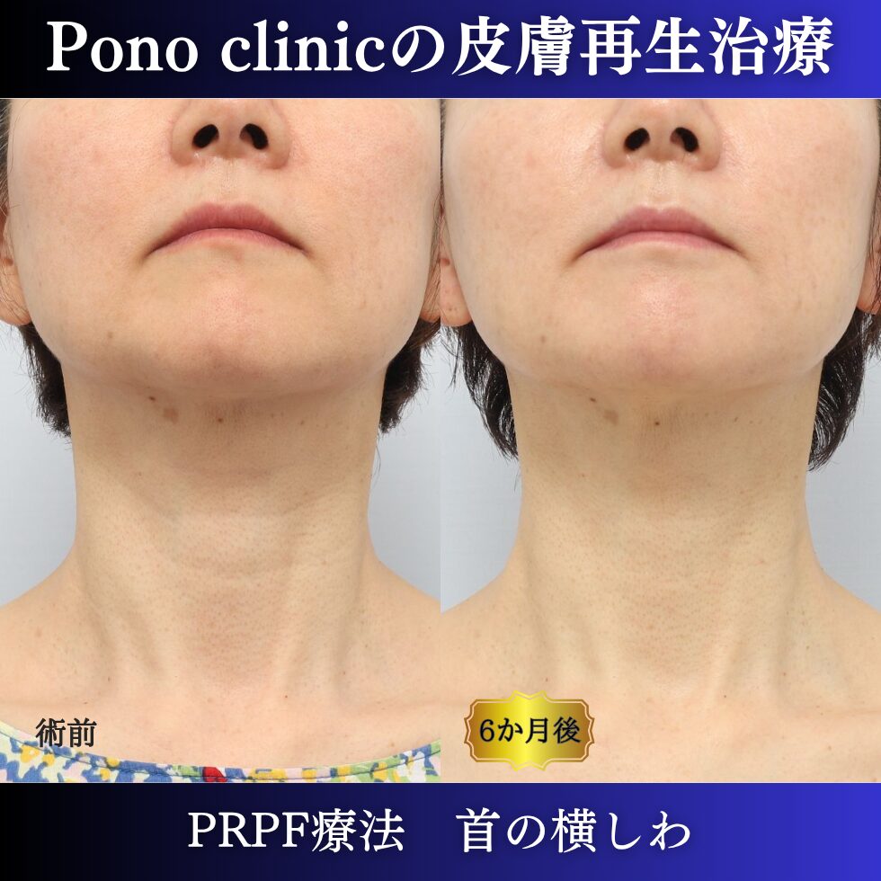 首のシワ、しわ治療、 50代の症例 (6)