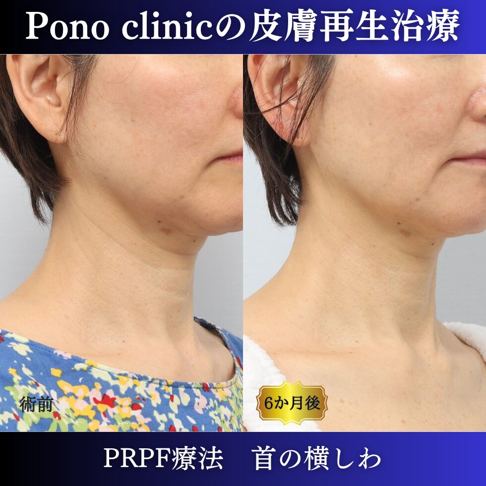 首のシワ、しわ治療、 50代の症例 (2)