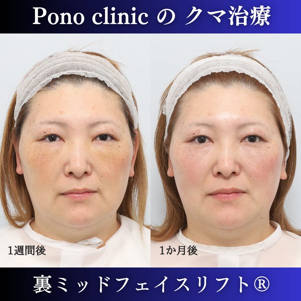 裏ミッドフェイスリフト®、骨膜下リフト、目の下のクマ取り、40代の症例 (1)